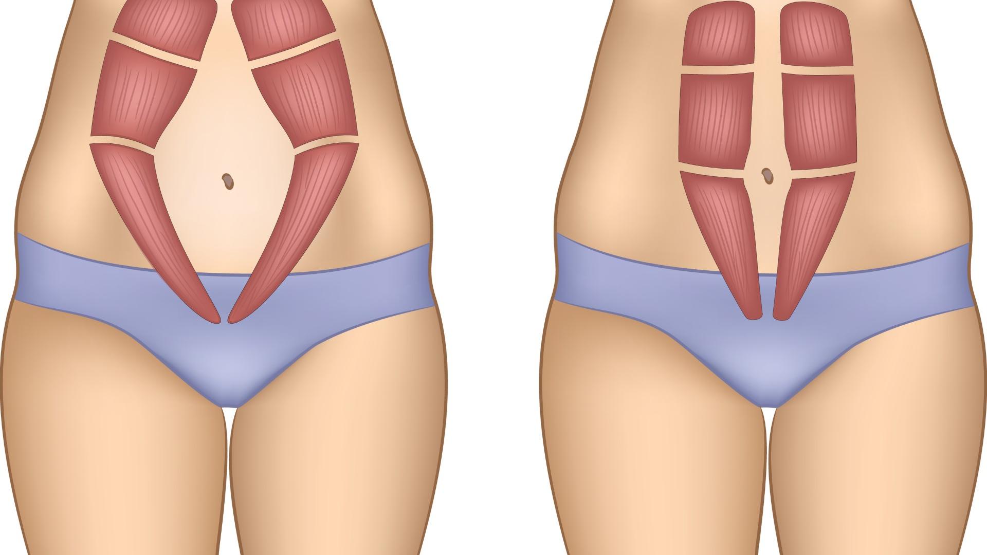 Rektusdiastase: Im Idealfall schließt sich die Lücke zwischen den geraden Bauchmuskeln nach der Schwangerschaft wieder.