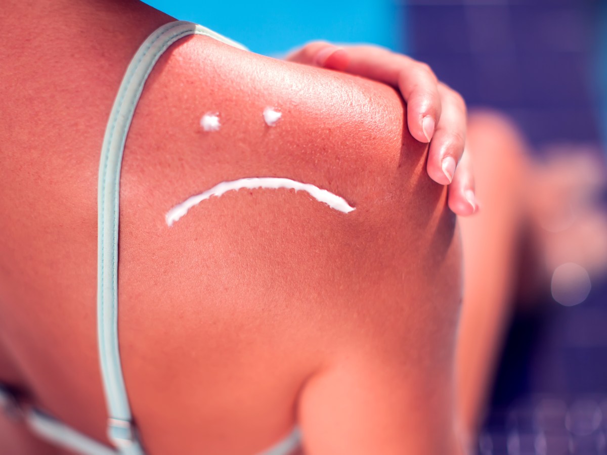 Starker Sonnenbrand mit Smiley aus Sonnencreme