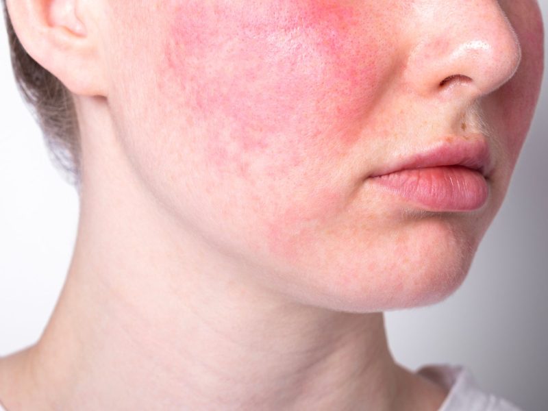 Frau mit Rosacea